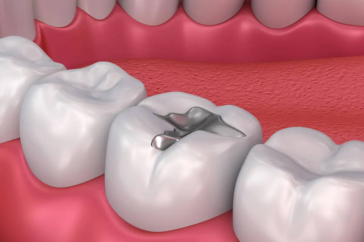 Bonded Fillings