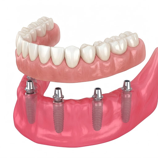 Step 3: The Denture