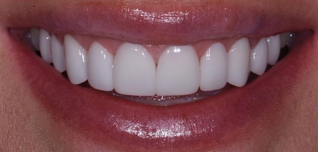 Before Whitening