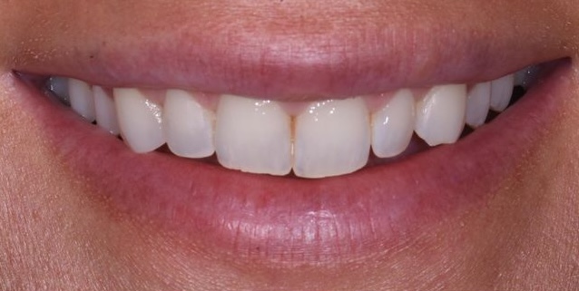 After Whitening