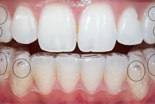 Clear Aligner Macro