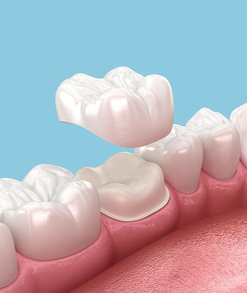 Dental Crowns